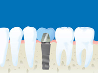インプラント治療